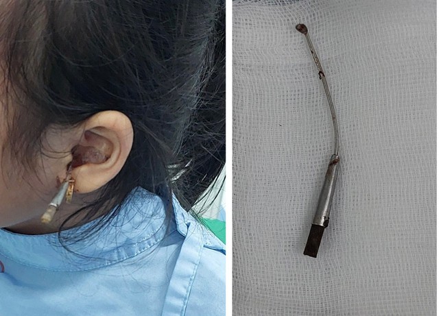 Kinh hãi bé gái 6 tuổi bị cây lấy dáy tai đâm xuyên vào tai giữa, bài học cho nhiều gia đình! - Ảnh 1.