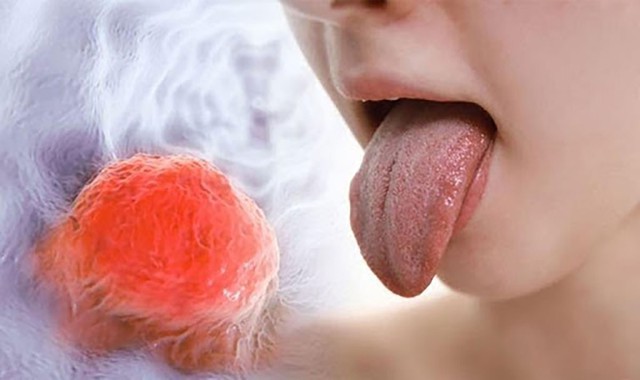 Ung thư lưỡi đáng sợ thế nào? Chuyên gia chỉ rõ 5 nhóm người này sẽ có nguy cơ cao - Ảnh 2.