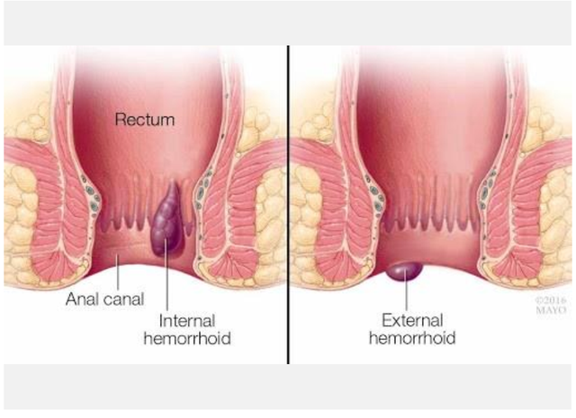 Không muốn bị trĩ ảnh hưởng cuộc sống, hãy tham khảo cách sau - Ảnh 1.