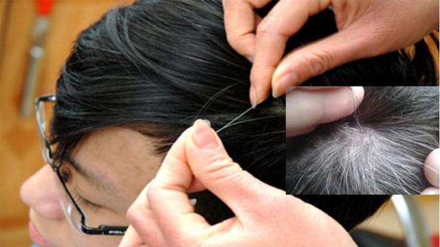 Còn trẻ mà bị tóc bạc sớm cùng với dấu hiệu này thì cần khám ngay còn kịp, đây là cách tốt nhất để ngăn chặn tóc bạc sớm! - Ảnh 2.