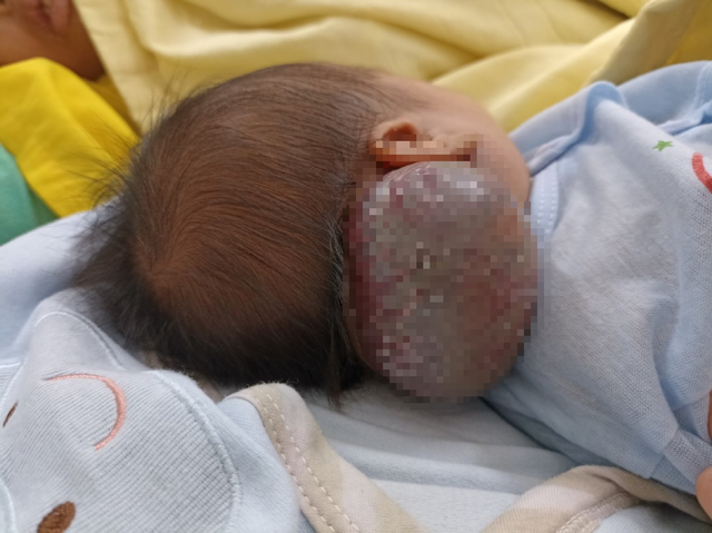 Hiếm gặp: Bé sơ sinh 14 ngày tuổi có khối u máu khổng lồ ở vùng cổ gáy - Ảnh 1.