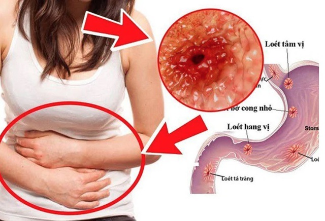 Cảnh giác với 5 nguyên nhân gây ung thư dạ dày, đây là 7 dấu hiệu điển hình cần được khám sớm! - Ảnh 4.