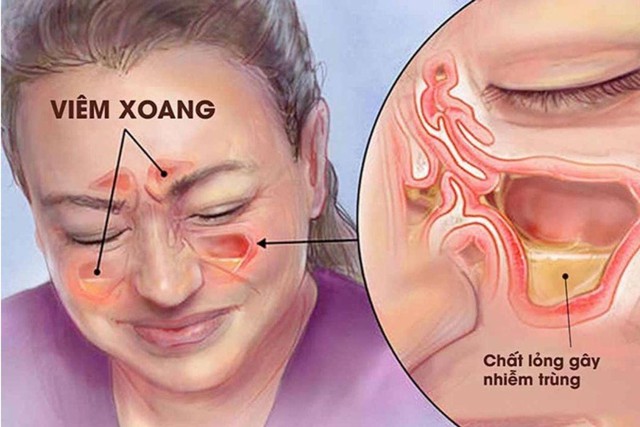 Viêm xoang gây đau đầu và cách phòng chống từ thảo dược - Ảnh 2.