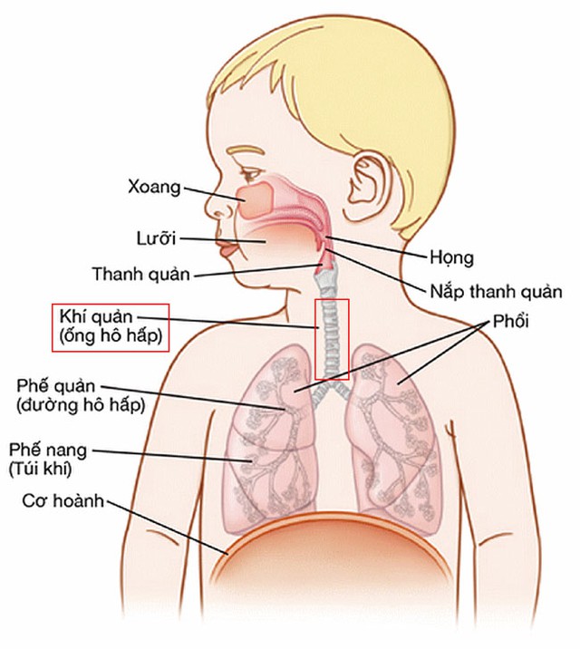 Mắc bệnh tim, hẹp khí quản bẩm sinh, bé gái 14 tháng tuổi được cứu sống - Ảnh 3.