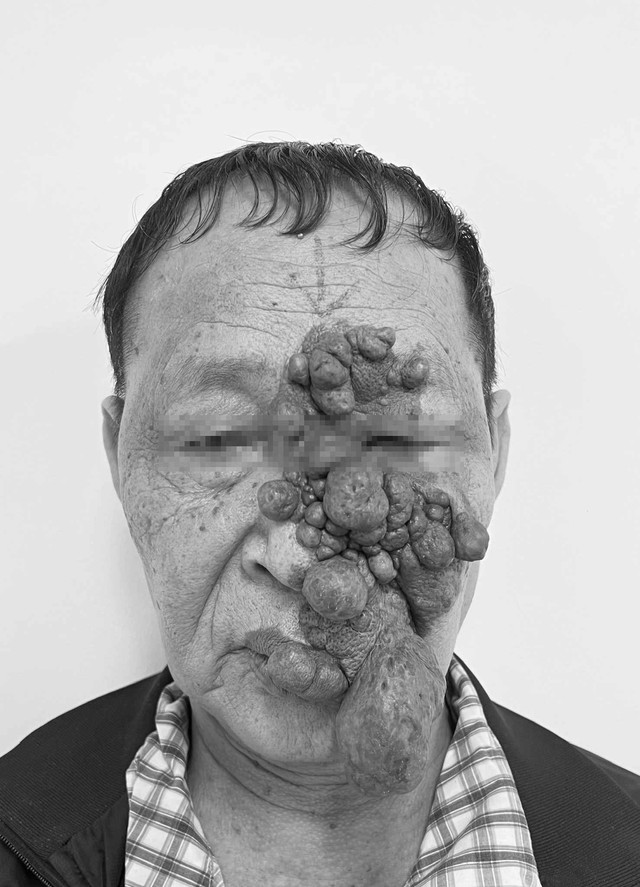 Bóc tách khối u như ‘chùm nho’ trên mặt nam bệnh nhân 74 tuổi - Ảnh 1.