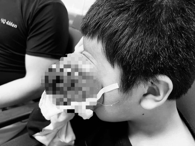 Hiếm gặp: Cậu bé 4 tuổi bị u quái hốc mắt chiếm gần nửa bên mặt - Ảnh 2.