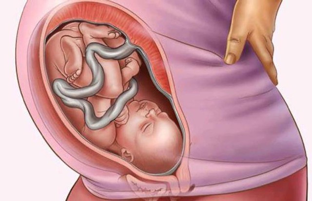 Dây rốn thắt nút: Sự hình thành và biến chứng nguy hiểm trong quá trình mang thai lẫn chuyển dạ - Ảnh 3.