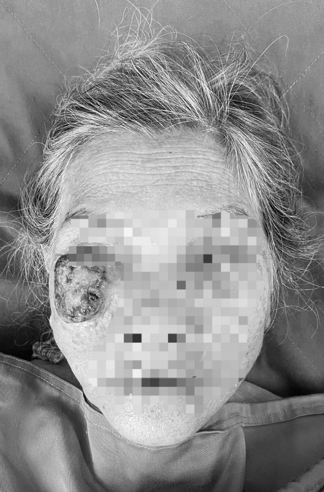 Từ nốt mụn ruồi vùng mi, cụ bà 98 tuổi bị khối u sùi loét lớn trên mặt - Ảnh 1.