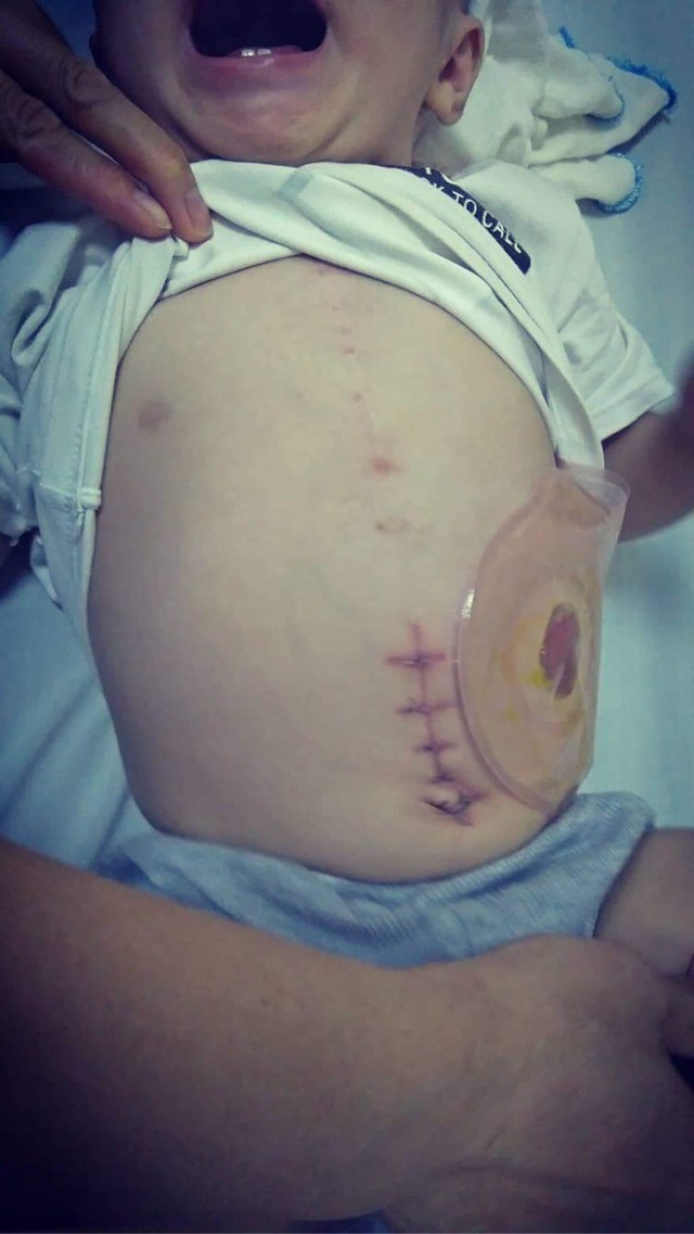 MS 838: Xót xa hoàn cảnh bé trai 13 tháng tuổi chào đời đã bất hạnh khi không có hậu môn, bị bệnh tim - Ảnh 3.