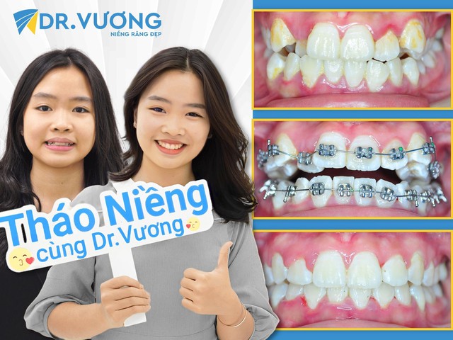 Loại mắc cài được chuyên gia Dr. Vương khuyên dùng trong niềng răng - Ảnh 3.