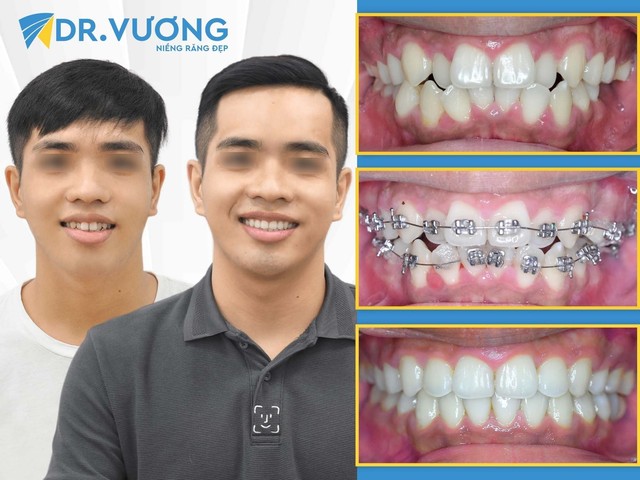 Loại mắc cài được chuyên gia Dr. Vương khuyên dùng trong niềng răng - Ảnh 5.