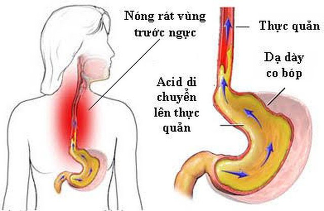 5 dấu hiệu trào ngược dạ dày người Việt rất dễ bỏ qua, 4 việc nhất định phải làm để phòng biến chứng nguy hiểm - Ảnh 2.