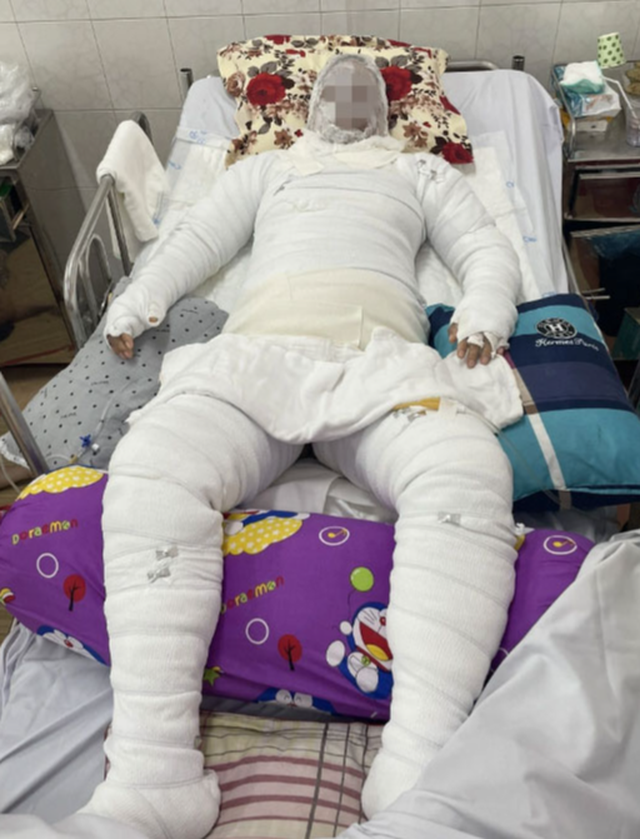 Thai phụ 37 tuần may mắn giữ được con khi bị bỏng nặng do gia đình dùng cồn nướng mực - Ảnh 1.