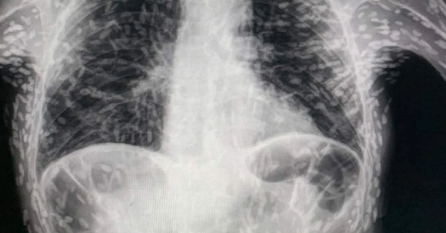 Người đàn ông ho 2 tháng không khỏi, chụp X-quang thì kinh ngạc phát hiện khắp người nổi đốm trắng: toàn là trứng ký sinh trùng - Ảnh 1.