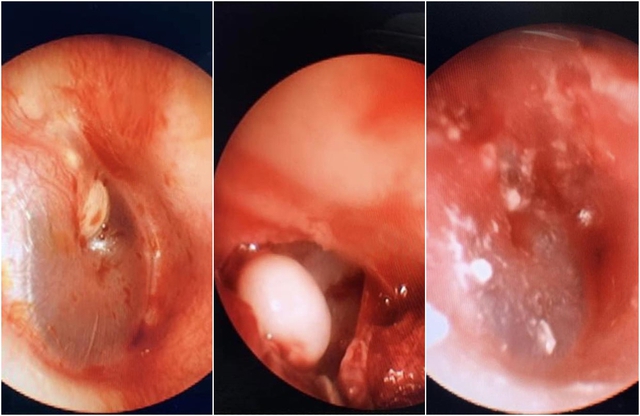 Tìm thấy &quot;hạt ngọc trai&quot; trong tai bé 5 tuổi do mắc bệnh hiếm gặp - Ảnh 2.