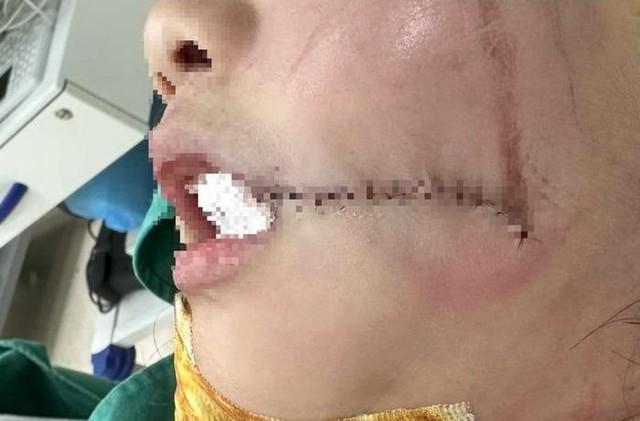 Bất cẩn, bé gái 7 tuổi bị thang máy đập vào mặt vỡ xương ổ răng - Ảnh 2.