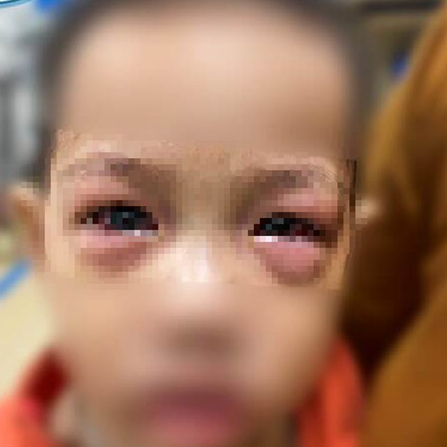 Bác sĩ Bệnh viện Nhi Trung ương khuyến cáo, gần 50 ca đau mắt đỏ trong một tháng, khoảng 20% có biến chứng nặng - Ảnh 1.