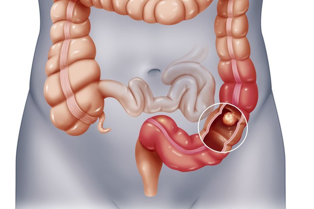 Người phụ nữ nhập viện vì ăn hồng ngâm sai cách, chuyên gia chi rõ ăn hồng ngâm cần tránh sai lầm này! - Ảnh 3.