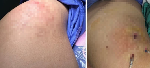 Người phụ nữ 31 tuổi bị áp xe mông sau tiêm filler làm đẹp ở spa - Ảnh 1.