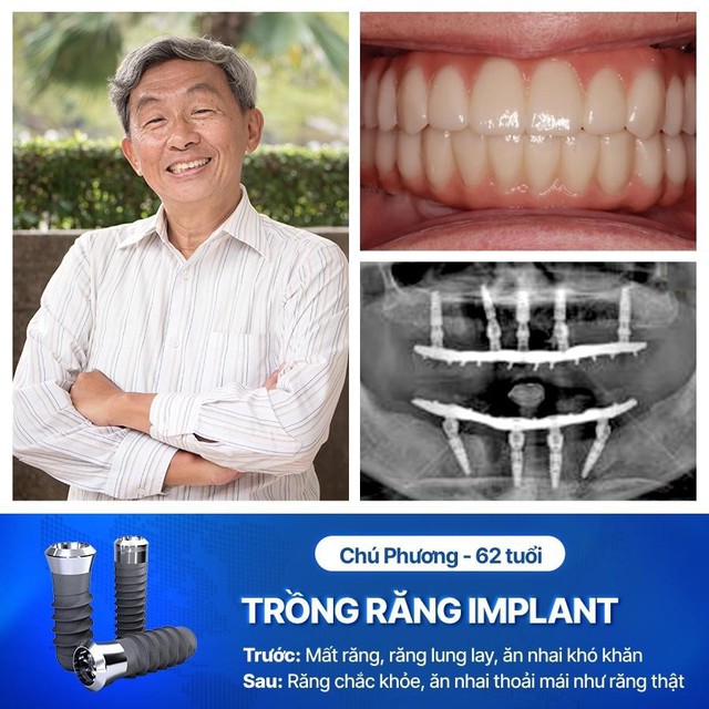 Trồng răng Implant từ tính an toàn cho mọi đối tượng - Ảnh 1.
