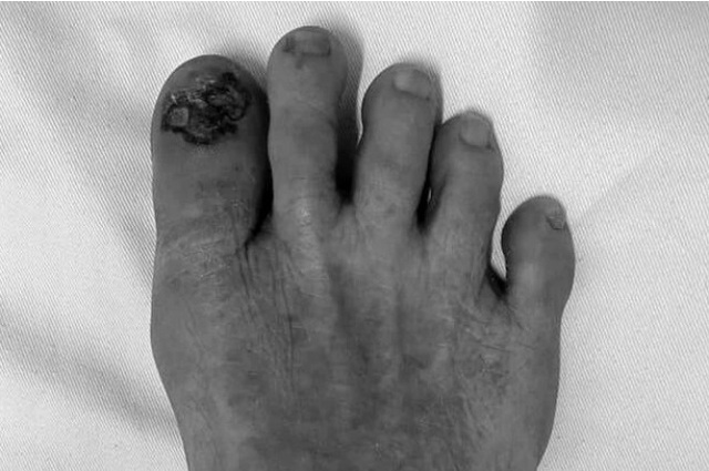 Một phụ nữ phát hiện ung thư từ vệt đen trên móng chân, người Việt cần cảnh giác với dấu hiệu này! - Ảnh 2.