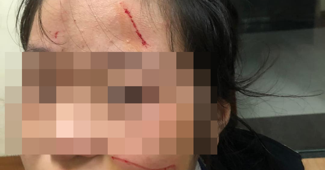 Thực hư thông tin nữ sinh Hà Nội bị rạch mặt tại trường học - Ảnh 1.