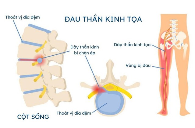 Đau thần kinh tọa - Nguyên nhân và cách hỗ trợ cải thiện- Ảnh 2.