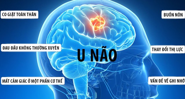 Người phụ nữ ở Phú Thọ bất ngờ phát hiện u não từ dấu hiệu rất nhiều người Việt mắc phải- Ảnh 3.