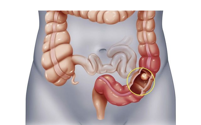 Người đàn ông 45 tuổi phát hiện mắc ung thư giai đoạn 3 vì trì hoãn làm việc này - Ảnh 4.