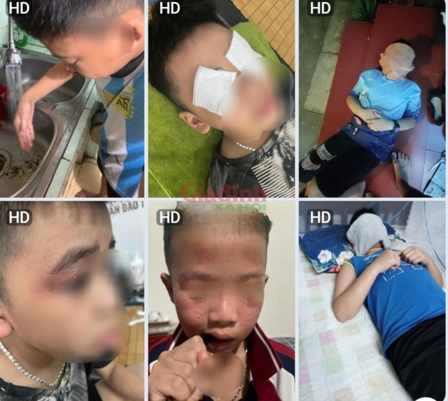 Hà Nội: Nhiều học sinh trường Tiểu học Hải Bối mẩn ngứa, đau rát mắt sau khi đi lớp về - Ảnh 2.