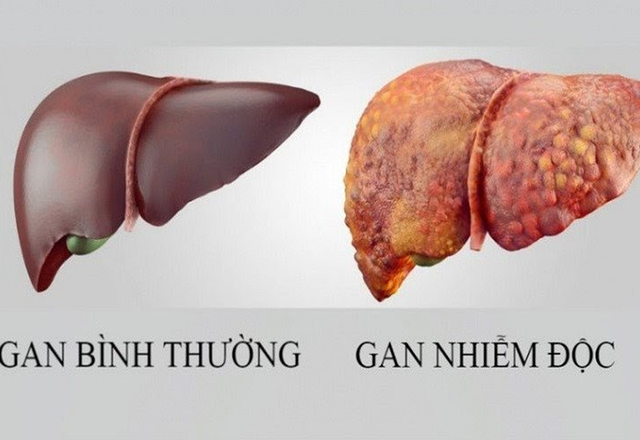 4 dấu hiệu cảnh báo gan của bạn không tốt, 3 nhóm người này cần giải độc gan để phòng bệnh - Ảnh 2.