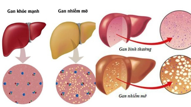 gan-nhiem-mo-gay-benh-171533316415266977189.jpg