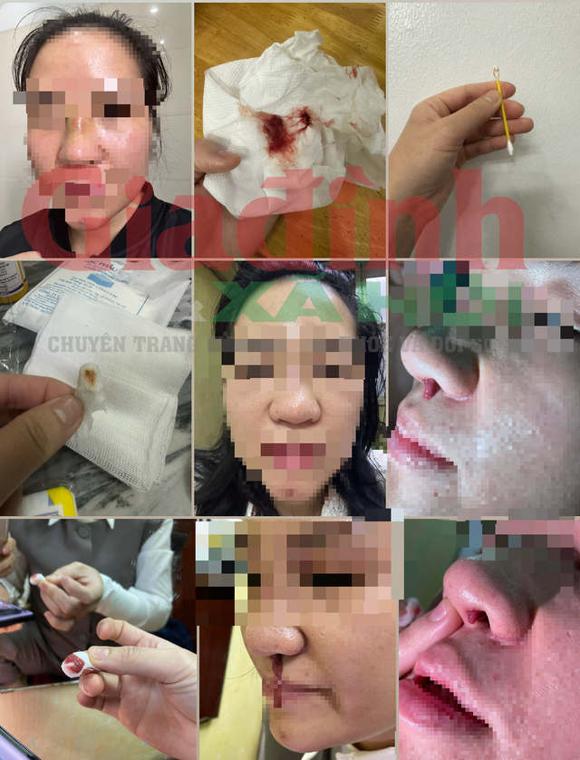 Thảm họa làm đẹp khi đến nhầm chỗ (bài 5): Nâng mũi ở Viện Thẩm mỹ Quốc tế ChangWon, một phụ nữ Hà Nội nhập viện cấp cứu, 'suýt' nhiễm trùng máu, phải chỉ định ngưng thai- Ảnh 2.