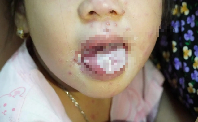 Bé gái bị nhiễm trùng nặng, miệng không thể ăn uống do mắc thủy đậu - Ảnh 1.