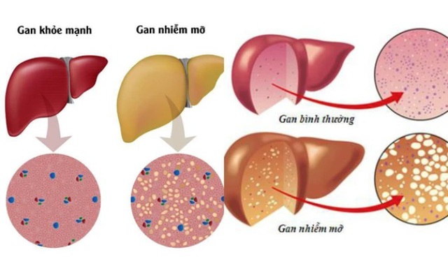 gan-nhiem-mo1-17151563097091149885795.jpg