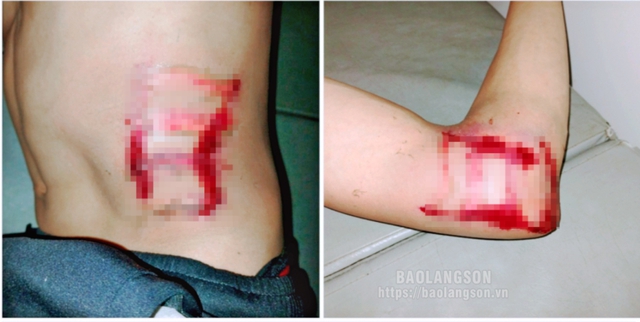 Thanh niên 29 tuổi ở Lạng sơn bị sét đánh ngất ngay trong phòng ngủ, lúc nửa đêm - Ảnh 2.