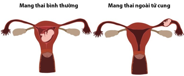 Người phụ nữ ở Phú Thọ suýt tử vong do mang thai ngoài tử cung, thấy dấu hiệu nguy hiểm này chị em cần cảnh giác- Ảnh 3.