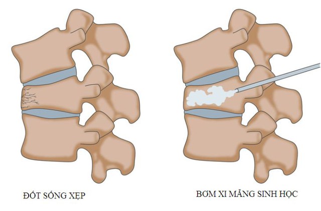 Người đàn ông 33 tuổi ở Phú Thọ dứt cơn đau cột sống nhờ cách này! - Ảnh 4.