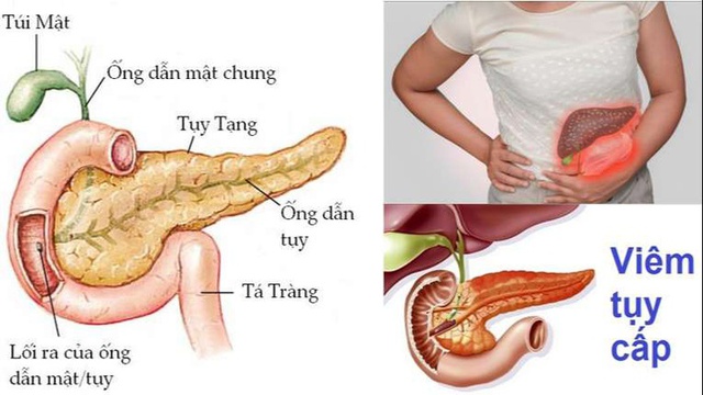 Người đàn ông ở Phú Thọ nhập viện gấp vì mỡ máu cao gấp 50 lần, bác sĩ khuyến cáo từ bỏ ngay thói quen này - Ảnh 2.