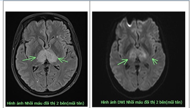 Đau đầu 4 ngày không đỡ, người phụ nữ 38 tuổi mắc bệnh nguy hiểm ở não