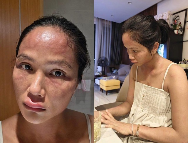 Hoa hậu H'Hen Niê bất ngờ chia sẻ mặt sưng nề, mẩn đỏ sau sinh con, căn bệnh cô mắc nguy hiểm thế nào? - Ảnh 1. Hoa hậu H'Hen Niê bất ngờ chia sẻ mặt sưng nề, mẩn đỏ sau sinh con, căn bệnh cô mắc nguy hiểm thế nào? - Ảnh 1.