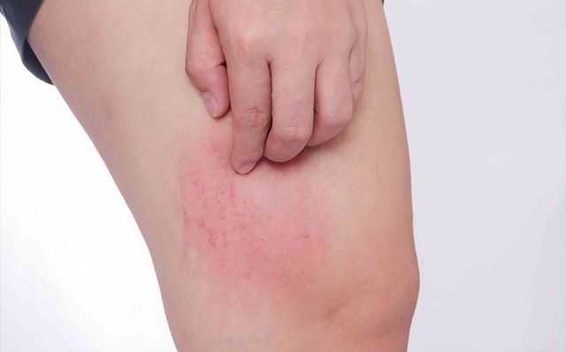 Hoa hậu H'Hen Niê bất ngờ chia sẻ mặt sưng nề, mẩn đỏ sau sinh con, căn bệnh cô mắc nguy hiểm thế nào? - Ảnh 3. Hoa hậu H'Hen Niê bất ngờ chia sẻ mặt sưng nề, mẩn đỏ sau sinh con, căn bệnh cô mắc nguy hiểm thế nào? - Ảnh 3.