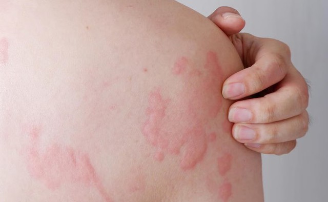 Hoa hậu H'Hen Niê bất ngờ chia sẻ mặt sưng nề, mẩn đỏ sau sinh con, căn bệnh cô mắc nguy hiểm thế nào? - Ảnh 2. Hoa hậu H'Hen Niê bất ngờ chia sẻ mặt sưng nề, mẩn đỏ sau sinh con, căn bệnh cô mắc nguy hiểm thế nào? - Ảnh 2.