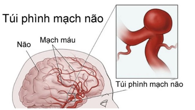Người phụ nữ 35 tuổi bị đau đầu, đi khám bất ngờ phát hiện phình mạch máu não nguy cơ vỡ cao - Ảnh 2. Người phụ nữ 35 tuổi bị đau đầu, đi khám bất ngờ phát hiện phình mạch máu não nguy cơ vỡ cao - Ảnh 2.
