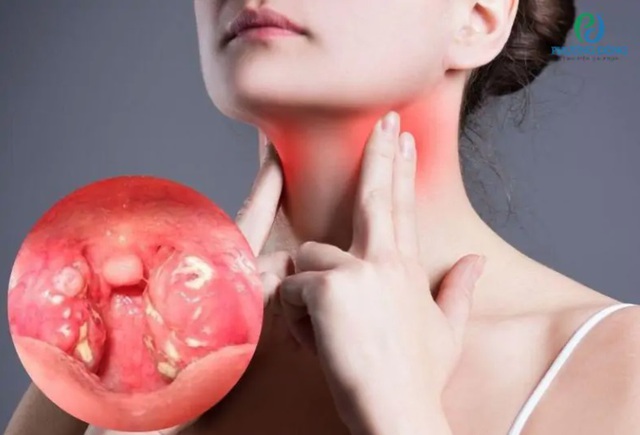 Bị viêm họng ngày lạnh, nhiều người vẫn mắc sai lầm khi ăn 5 món quen thuộc này - Ảnh 1. Bị viêm họng ngày lạnh, nhiều người vẫn mắc sai lầm khi ăn 5 món quen thuộc này - Ảnh 1.