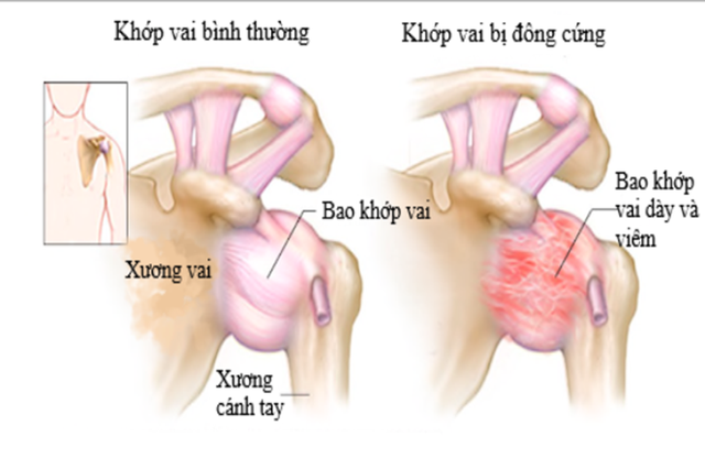 Viêm khớp vai: Cảnh giác với dấu hiệu nhiều người Việt bỏ qua - Ảnh 1.