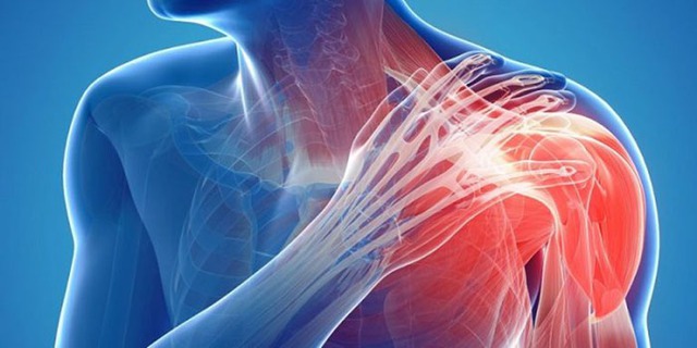 Viêm khớp vai: Cảnh giác với dấu hiệu nhiều người Việt bỏ qua - Ảnh 2.