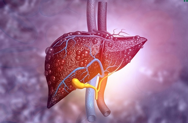 Người đàn ông 49 tuổi may mắn phát hiện bệnh lý gan nguy hiểm nhờ 1 việc mà rất nhiều người Việt bỏ qua - Ảnh 1.