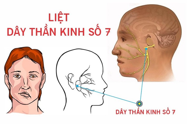 Thanh niên 23 tuổi ở Hà Nội méo miệng, liệt dây thần kinh số 7 thừa nhận mắc sai lầm này khi tắm đêm - Ảnh 1. Thanh niên 23 tuổi ở Hà Nội méo miệng, liệt dây thần kinh số 7 thừa nhận mắc sai lầm này khi tắm đêm - Ảnh 1.
