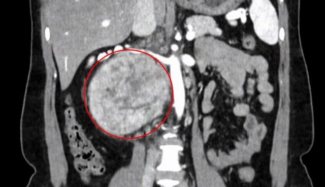 Nhầm lẫn đau lưng do tập thể thao, người phụ nữ đi khám phát hiện khối u hạch bạch huyết 'khổng lồ' - Ảnh 1. Nhầm lẫn đau lưng do tập thể thao, người phụ nữ đi khám phát hiện khối u hạch bạch huyết 'khổng lồ' - Ảnh 1.